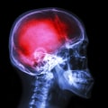 Can pain change the brain?