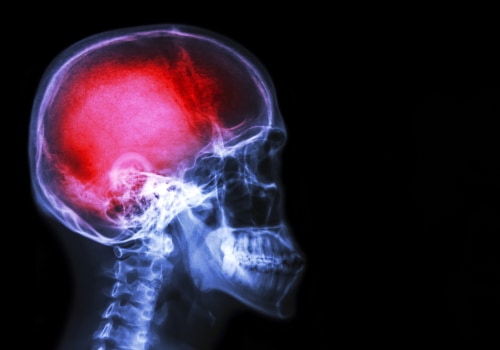 Can pain change the brain?